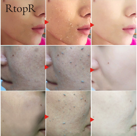 RtopR Skin Care Face Exfoliating Cream Whitening Moisturizer Repair Facial Scrub Skin Cleaner Acne Blackhead Treatment Remove Face gel